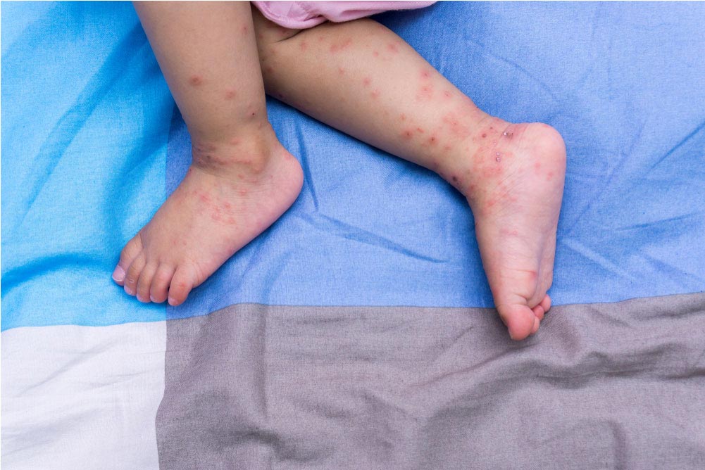 What Is The Rubella Syndrome