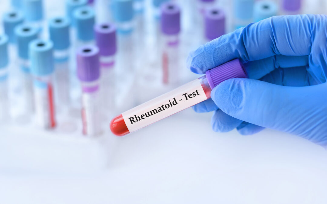 Recombinant Rheumatoid Factor: Elevating Autoimmune Diagnostics